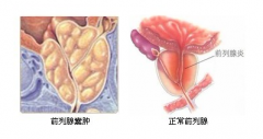在治疗前列腺囊肿时会有哪些误区呢?